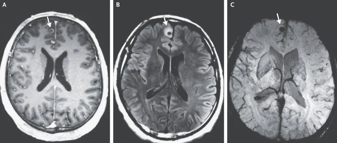 Le scanner de l'homme avec un ténia dans le cerveau